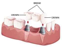 Oral Surgery teeth crown and bridges Regency Dental Omaha