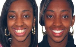 Six Month Smiles before and after regency dental