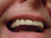 Dental Crowns FAQ’s