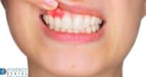 Bleeding Gums