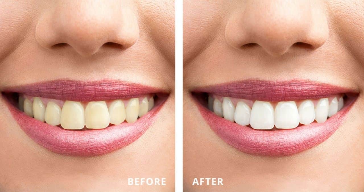 How Teeth Whitening Works