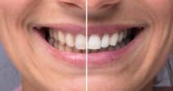 teeth whitening risks