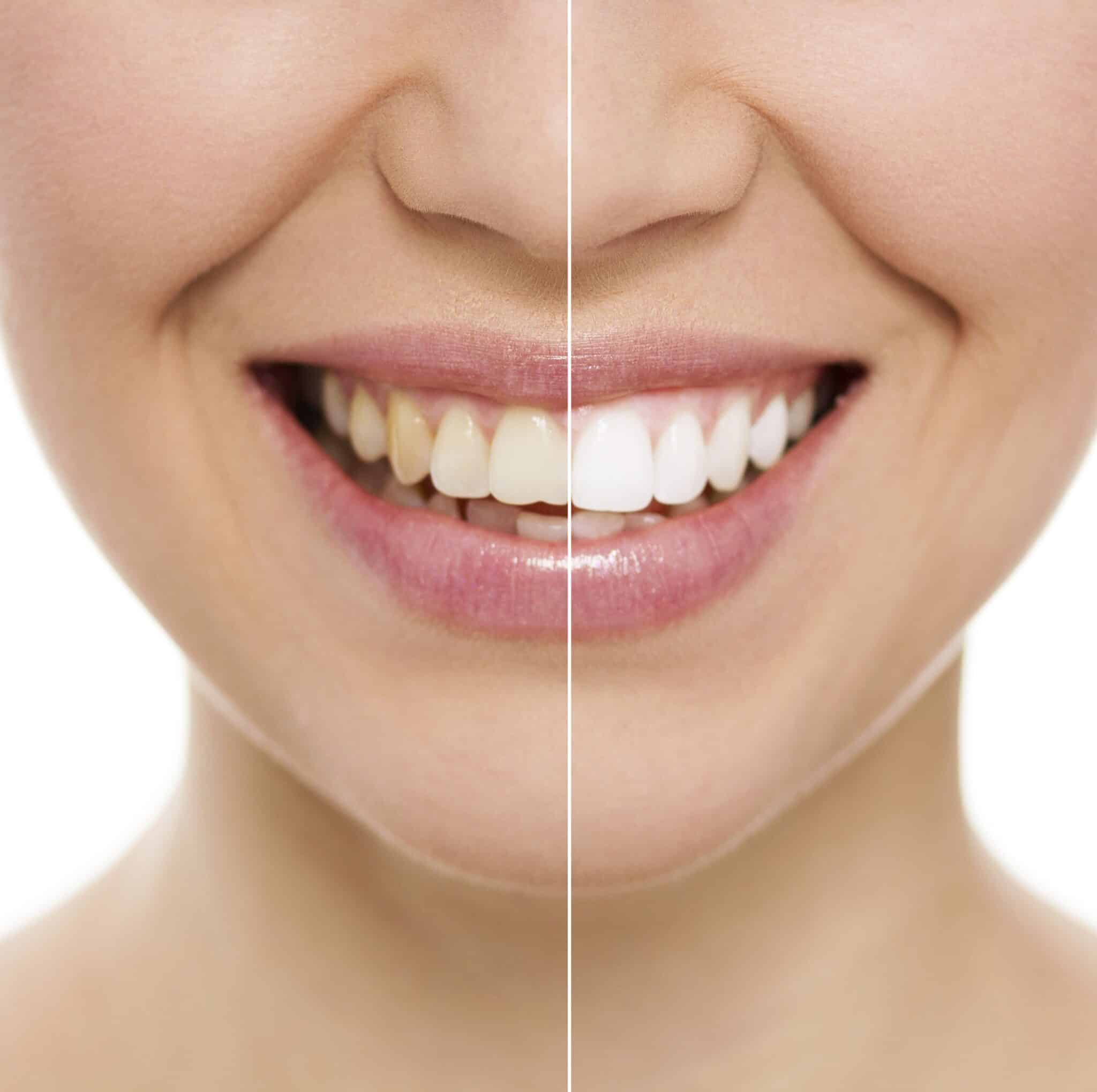 Professional Teeth Whitening in Omaha