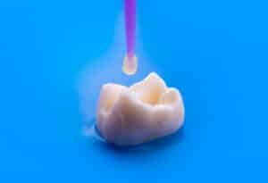 dental bonding omaha