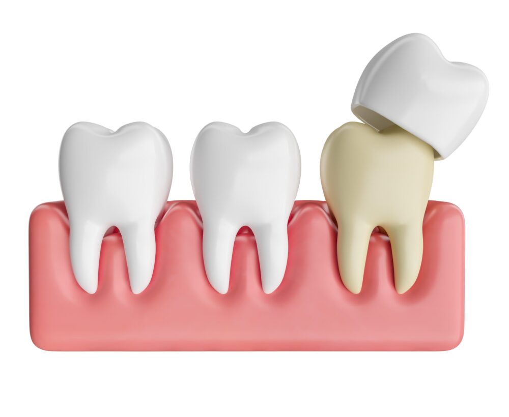 dental crowns omaha