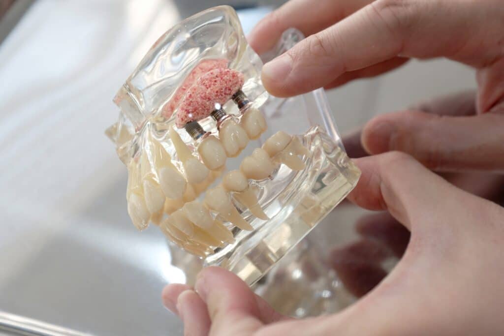 dental implants omaha