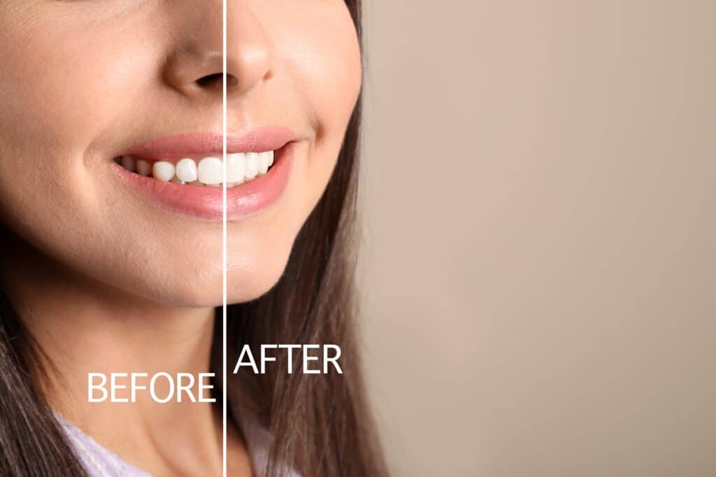 gum contouring omaha